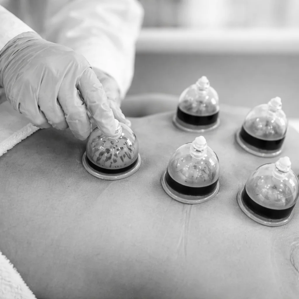 Hijama / Hacamat